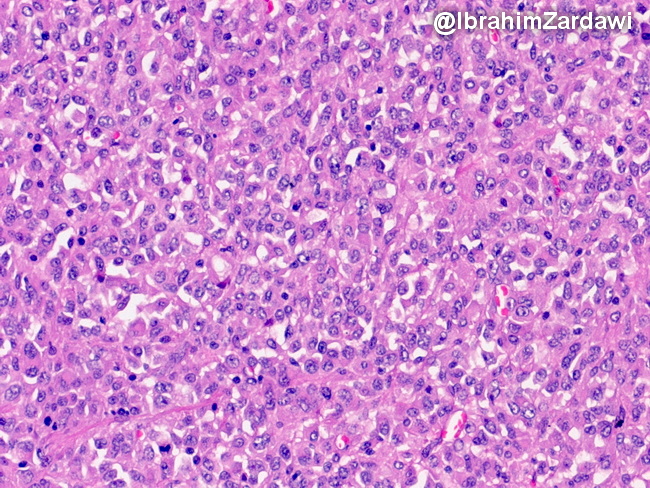 Adrenal rhabdoid tumour7_Zardawi_resized.jpg